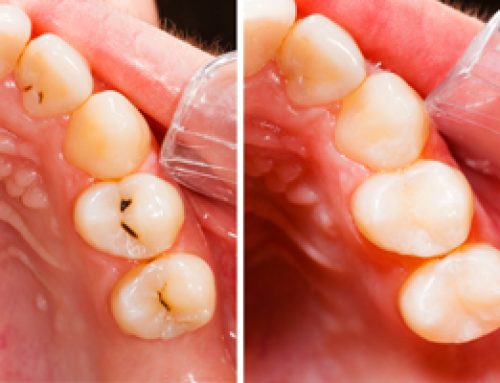 Metal-Free Fillings