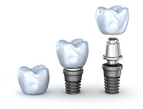 Dental Implants to Restore Your Teeth
