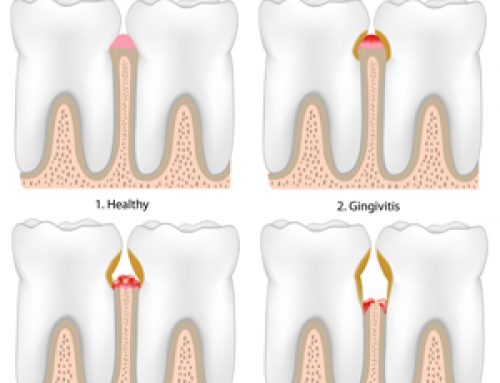 Laser Treatment Saves Teeth