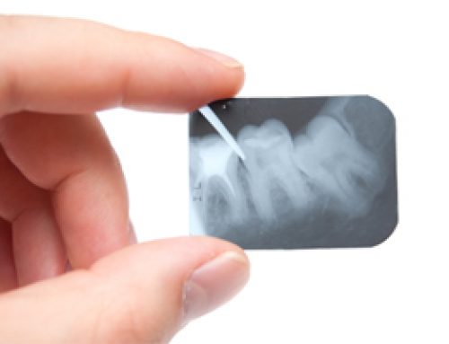 Dental X-Ray FAQs