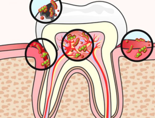 Can You Catch a Cavity?