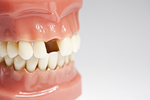 Artificial Jaw with Missing Tooth