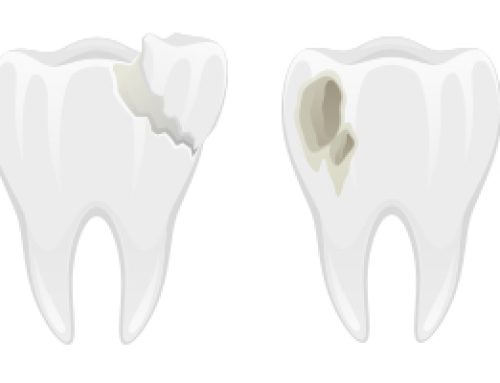 Even Tiny Tooth Cracks Need Attention